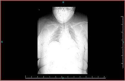 A Case Report of the Reconstruction of a Bone Defect Following Resection of a Comminuted Fracture of the Lateral Clavicle Using a Titanium Prosthesis